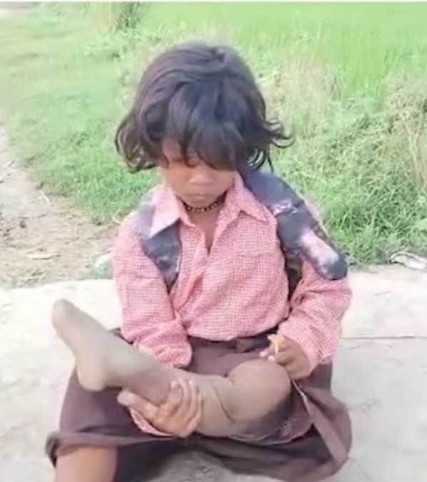 मासूम रागिनी के लिए कस्टमाइज्ड कृत्रिम पैर (Artificial Leg) photo 1