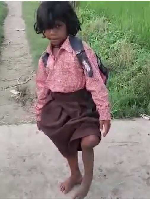 मासूम रागिनी के लिए कस्टमाइज्ड कृत्रिम पैर (Artificial Leg) photo 2